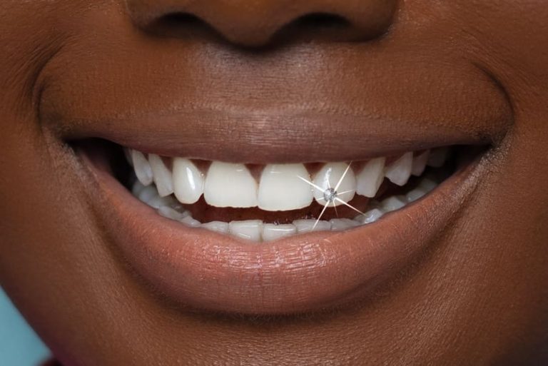 Cosmetic Dentistry Close-up of a smiling person with a sparkling tooth gem on their white teeth, showcasing a dental aesthetic service she received at German Ozone Medical Centre