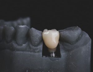 a close-up of a model of Dental Implant by German Ozone Medical Centre in teeth