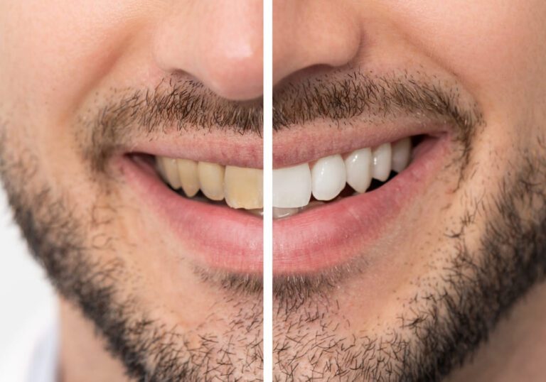 Before and after teeth whitening comparison on a man's smile