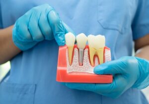 How Much Do Dental Implants Cost in Ghana? - GERMAN OZONE MEDICAL CENTRE