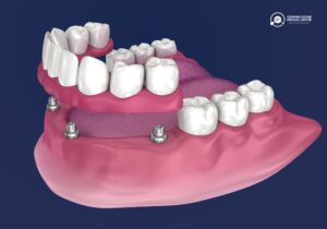 3D illustration of implant-supported dentures attached to dental implants.