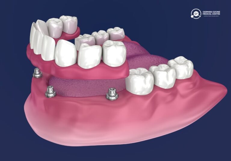 3D illustration of implant-supported dentures attached to dental implants.