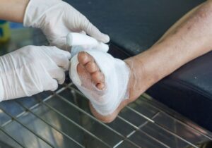 A healthcare professional dressing a diabetic foot wound with sterile gauze, showing close-up care for diabetic ulcer treatment.