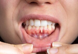 Close-up of receding gums on lower front teeth in an adult patient.